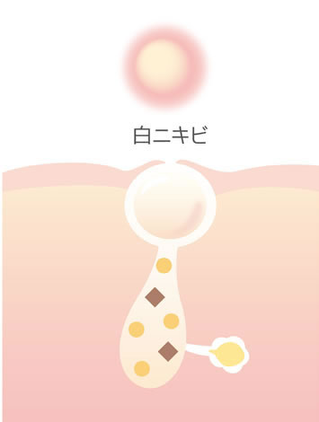 にきび