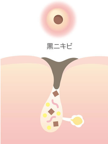 にきび